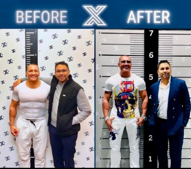 from-five-feet-to-six-hugos-journey-through-leg-lengthening-surgery-and-its-life-changing-impact.jpg